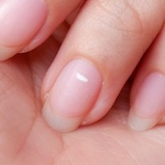 Photo for blog article titled Do your fingernails look like this? Signs of zinc deficiency